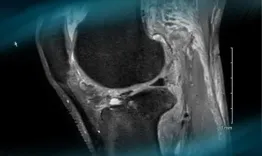 Management of an ACL reconstruction in a professional disabled sport with transtibial amputation