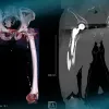 Management of a peri prostetic femoral fracture